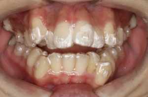 志木　歯医者　矯正