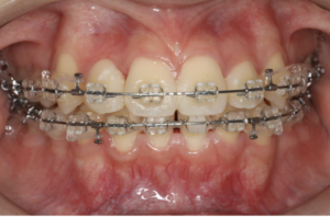 志木　矯正　歯医者