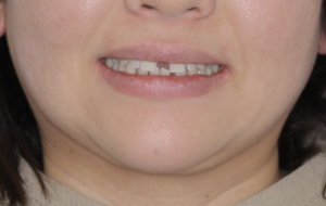 志木　矯正　歯医者