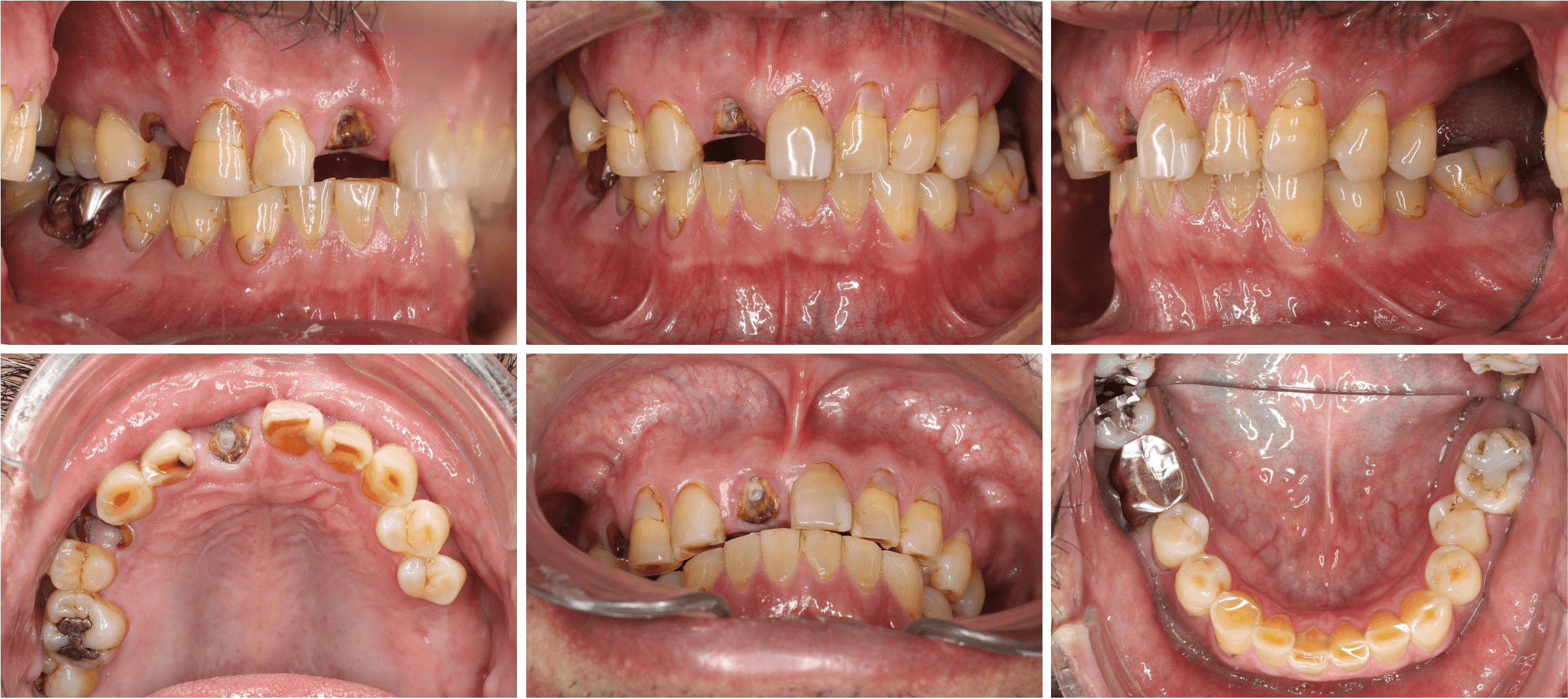 志木　歯医者　インプラント