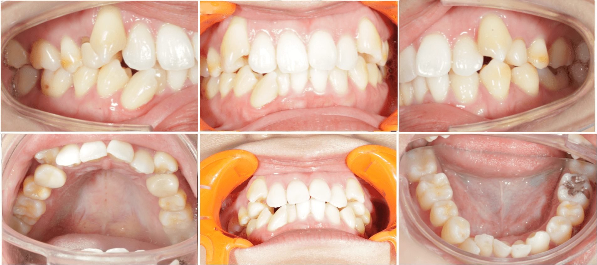 志木 歯医者 矯正