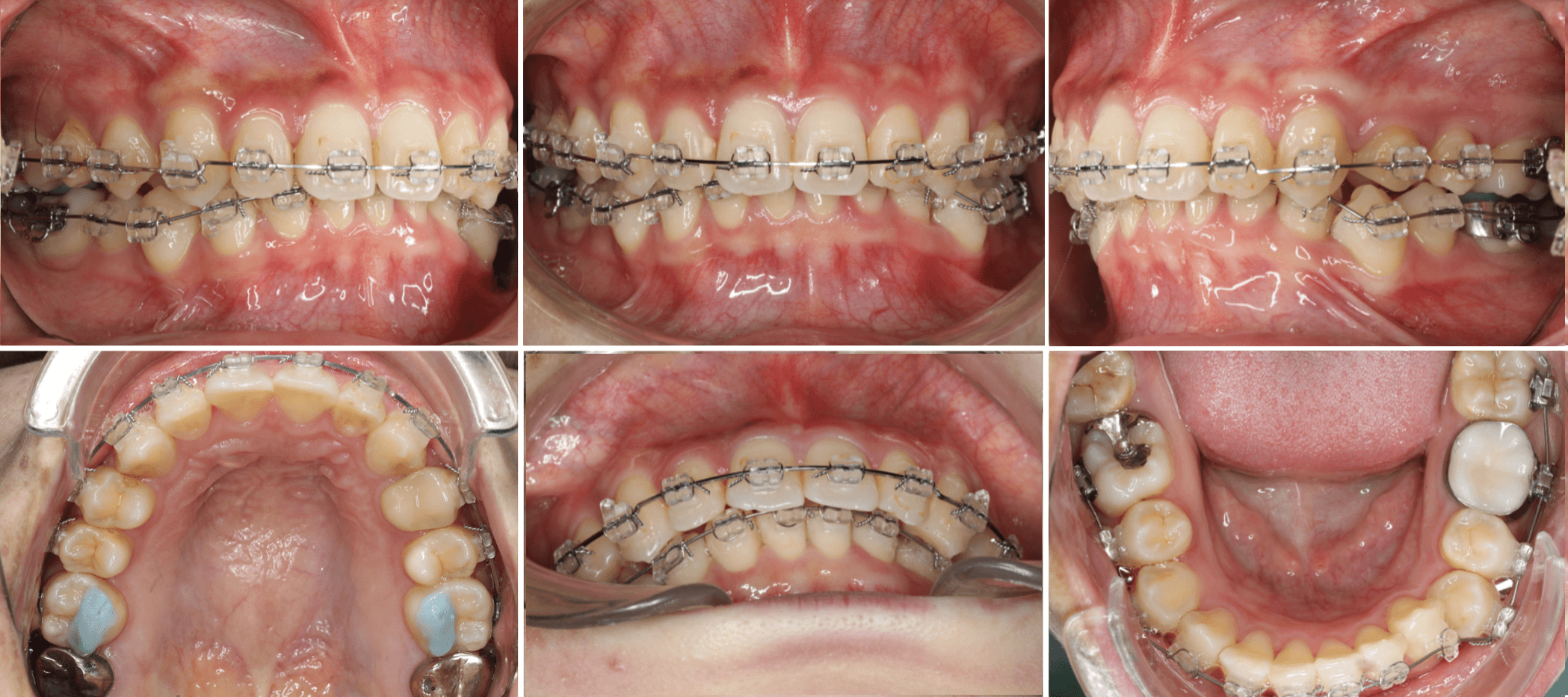 志木 歯医者 矯正