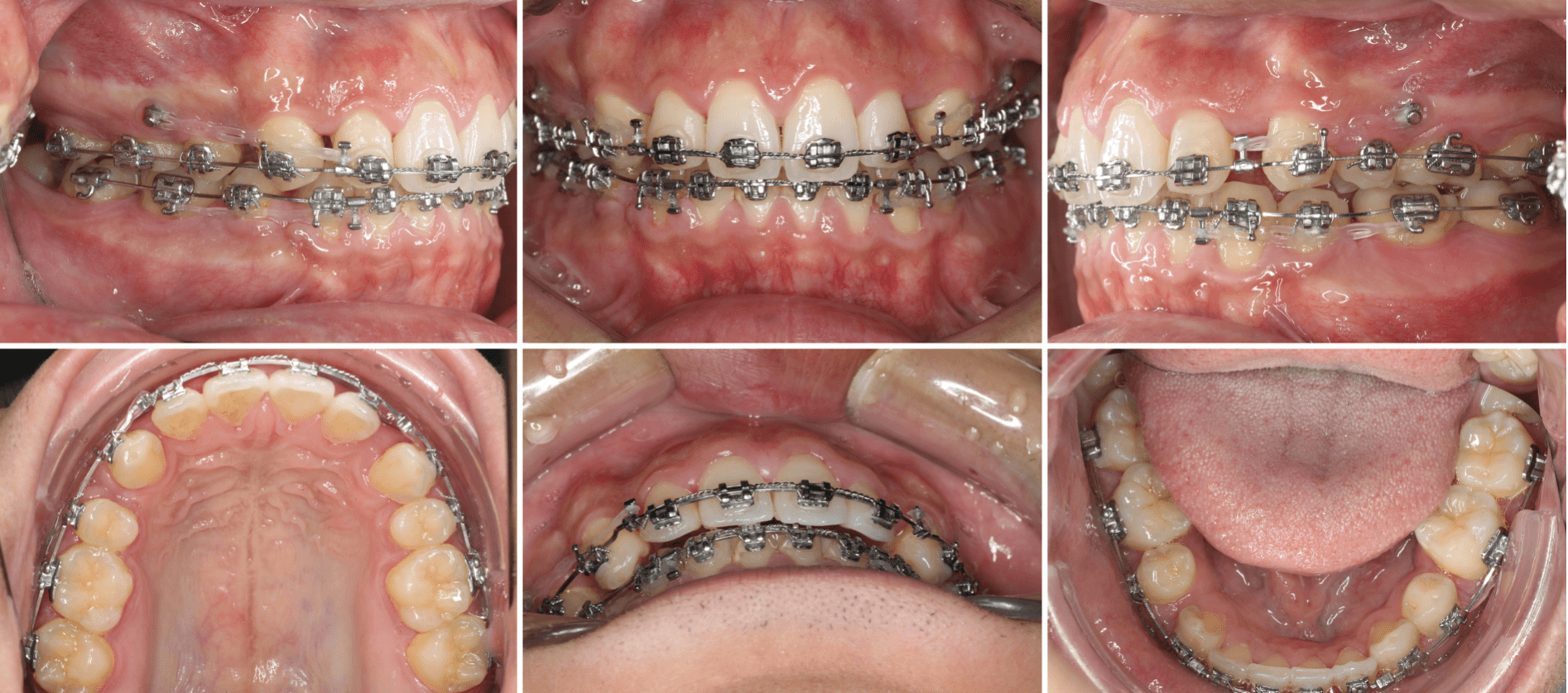 志木 歯医者 矯正