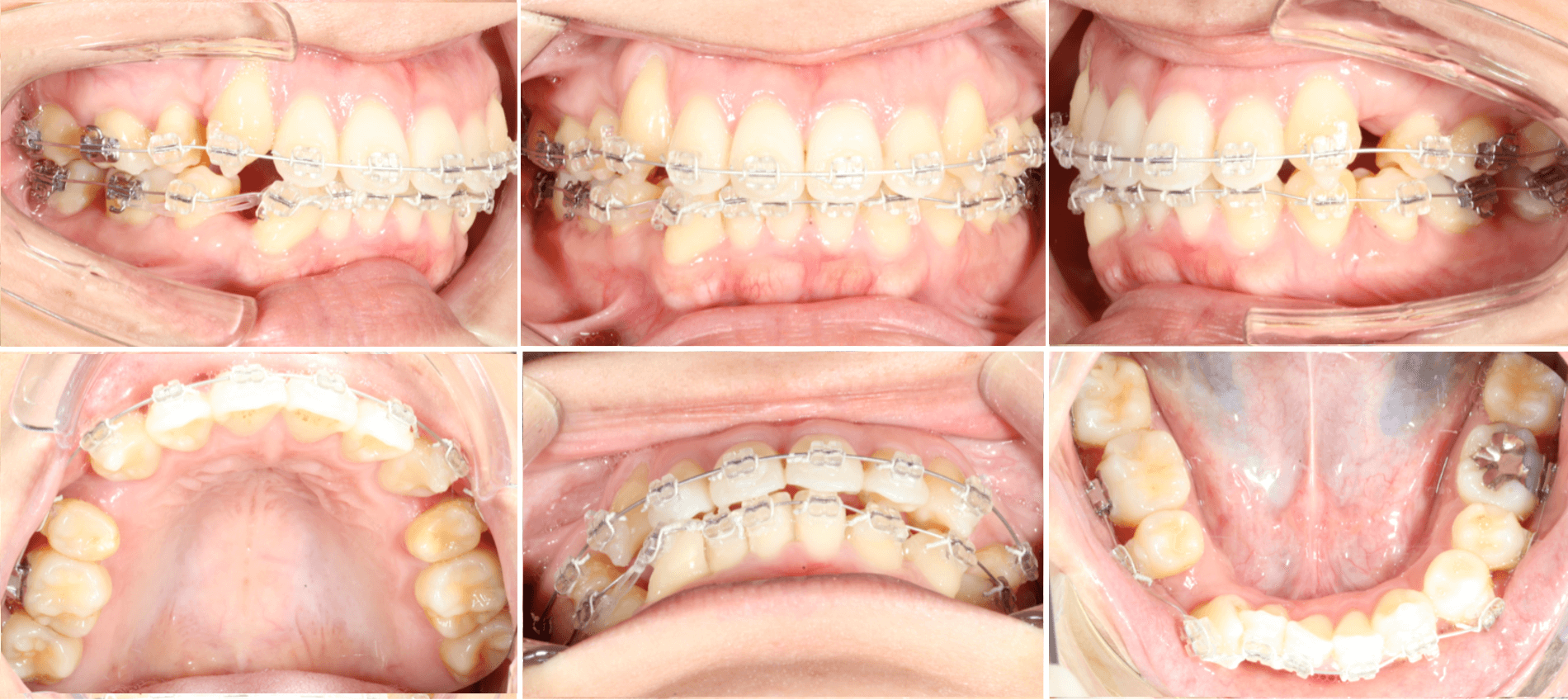 志木 歯医者 矯正