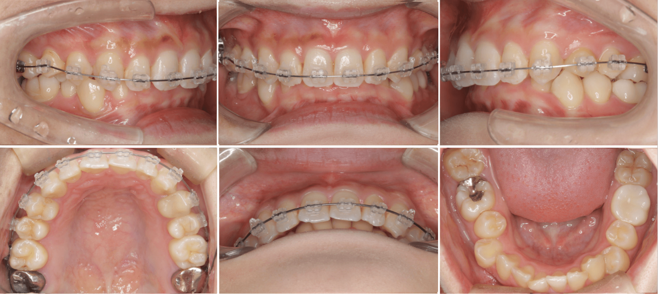 志木 歯医者 矯正