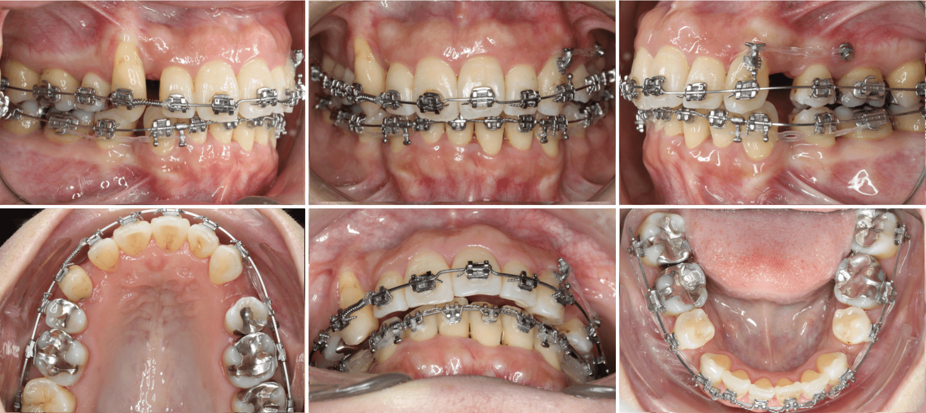 志木　歯医者　矯正