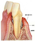 歯周病