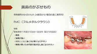 奥歯の被せ物